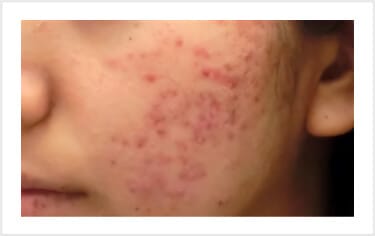 炎症性ニキビ（赤ニキビ）【画像】