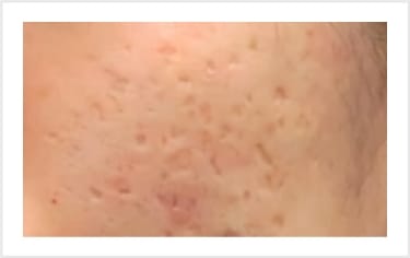 ニキビ跡（色素沈着、クレーター）【画像】