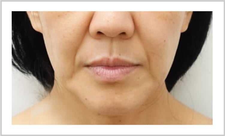 たるみの改善・予防【画像】