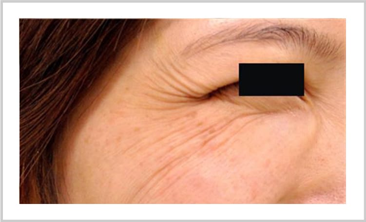 シワ・ほうれい線の改善【画像】