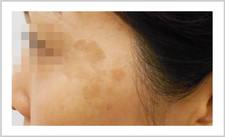 シミ・くすみの改善【画像】