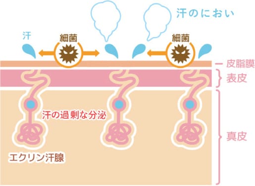 多汗症【画像】