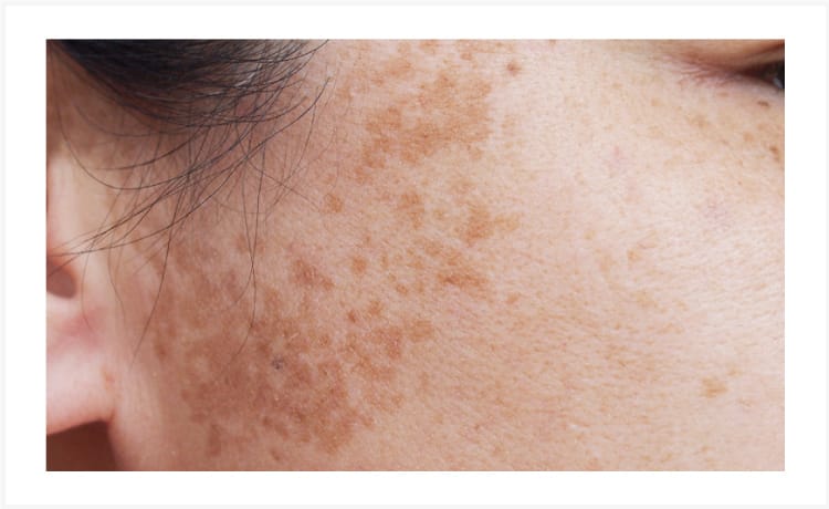 茶あざ【画像】