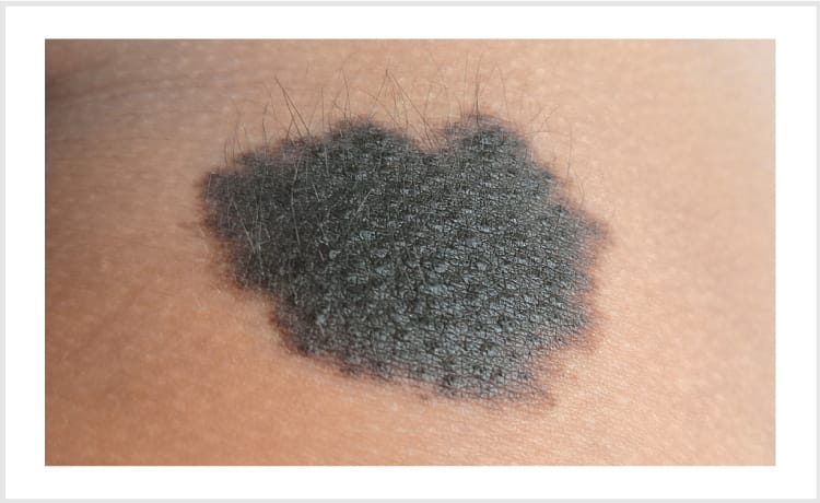 黒あざ【画像】