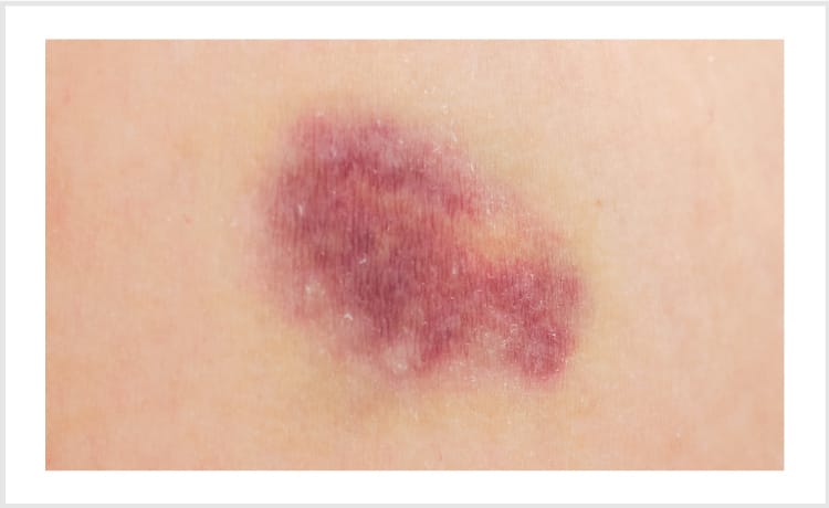 赤あざ【画像】