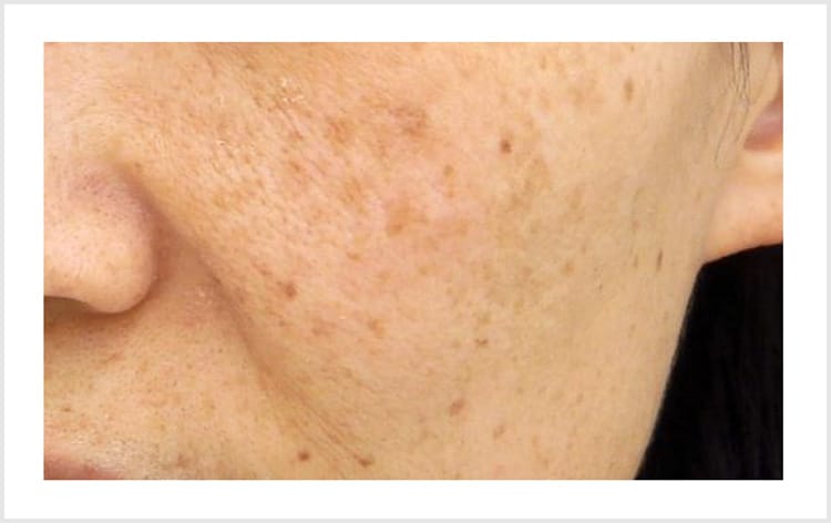 乾燥くすみ【画像】