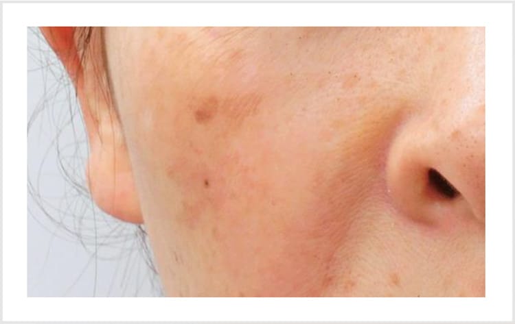 黄ぐすみ・糖化くすみ【画像】