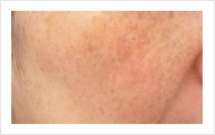 メラニンくすみ【画像】