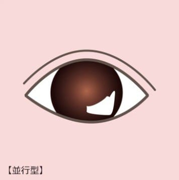 平行型【画像】