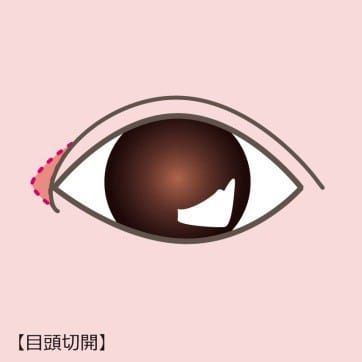 目頭切開【画像】