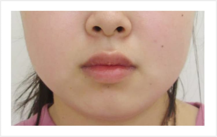 むくみ顔・丸顔【画像】