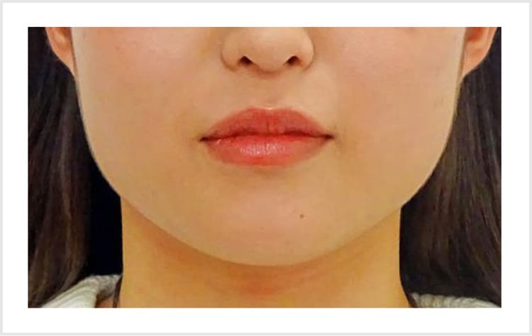 ベース顔・エラ張り【画像】