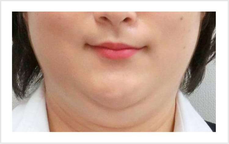 二重あご【画像】