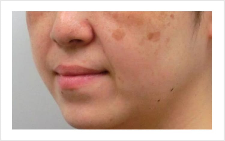 広範囲に広がった肝斑【画像】