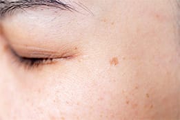 肝斑（かんぱん）とは【画像】