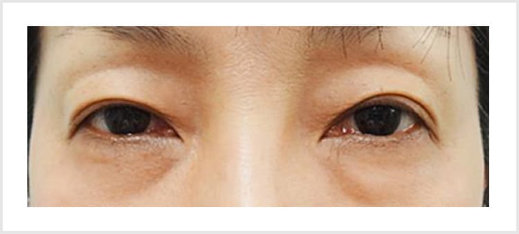 茶クマの原因と改善方法【画像】