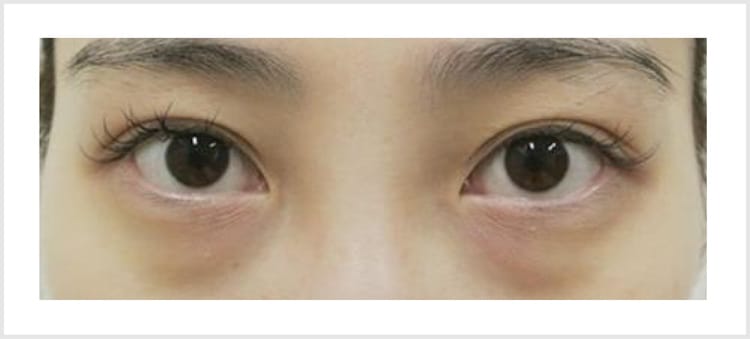 青クマの原因と改善方法【画像】