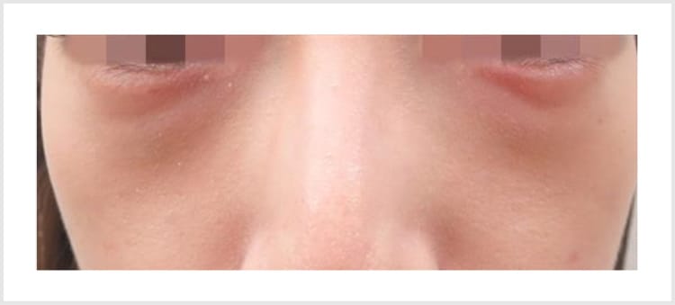 赤クマの原因と改善方法【画像】