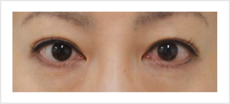 黒クマ・くぼみの原因と改善方法【画像】