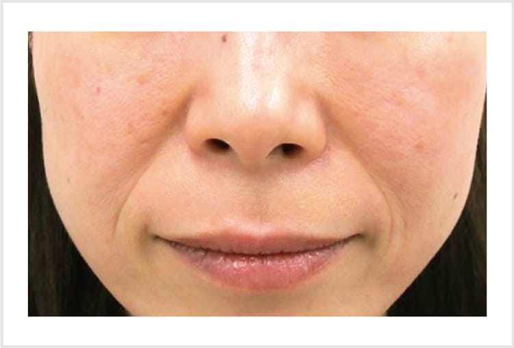 ヒアルロン酸よるシワの改善【画像】