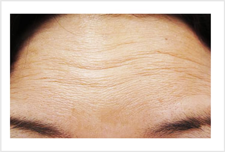 ボツリヌス注射によるシワの改善【画像】