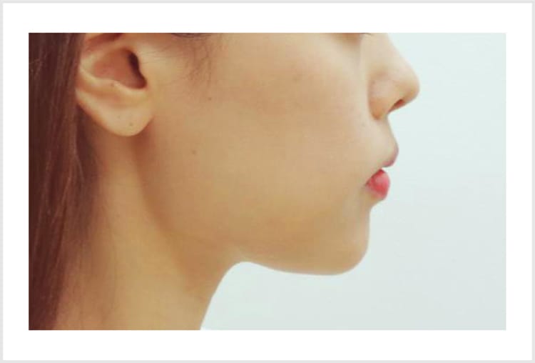 注入による鼻・輪郭形成（額・ホホ・アゴ）【画像】