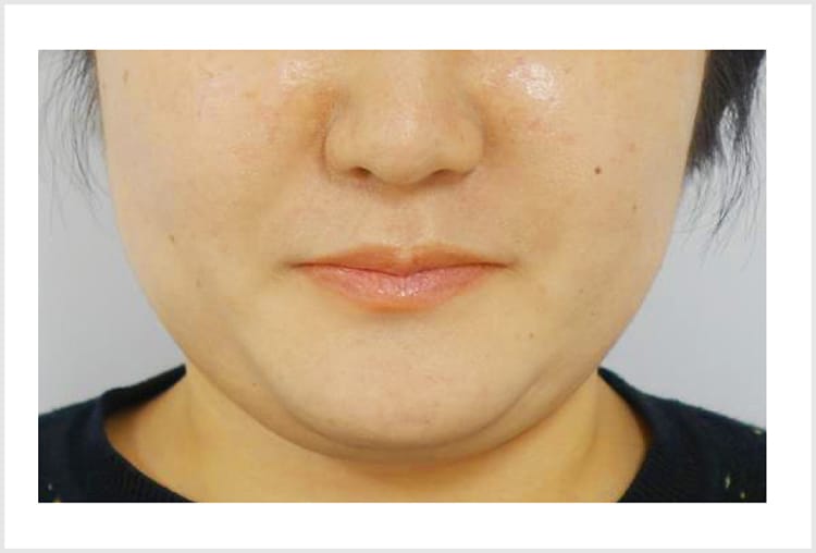 注入による小顔・痩身術【画像】