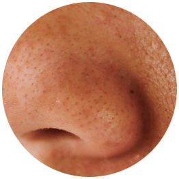 毛穴の黒ずみ・ザラつき【画像】