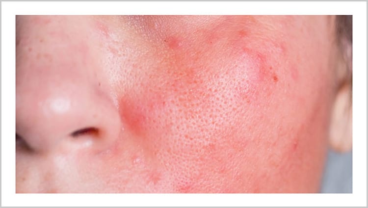 炎症による赤ら顔【画像】