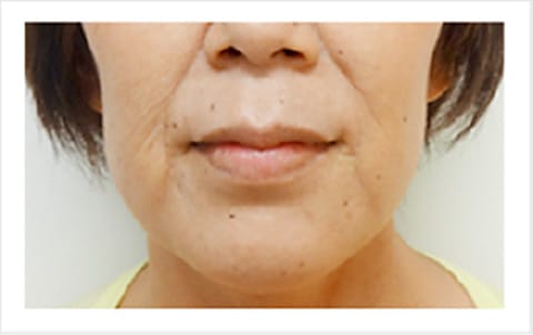 ホホ・フェイスラインのたるみ【画像】