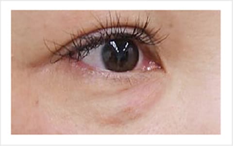 目元のたるみ【画像】