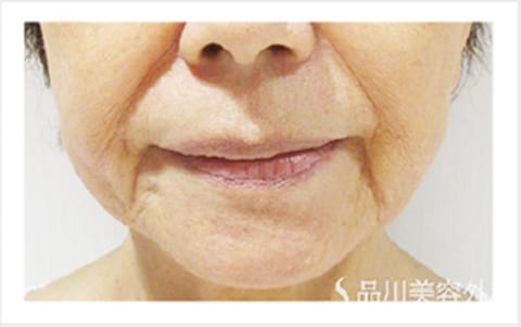 口もとのたるみ【画像】