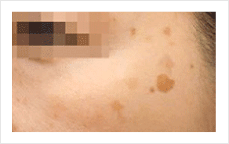 （老人性色素斑）ろうじんせいしきそはん【画像】