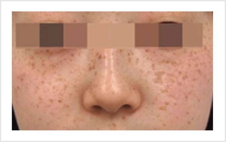 （雀卵斑）じゃくらんはん【画像】