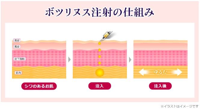 ボツリヌス注入の仕組み【画像】