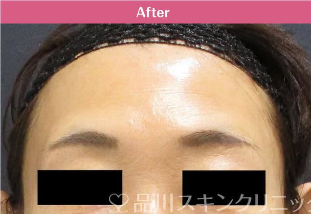 アラガン社製ボツリヌス注射×美肌注射 症例写真 After