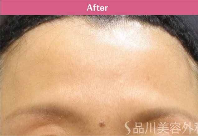 アラガン社製ボツリヌス注射×美肌注射 症例写真 After