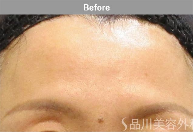 アラガン社製ボツリヌス注射×美肌注射 症例写真 Before