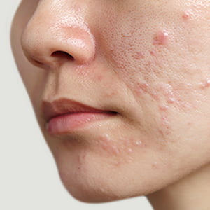 梅田院のニキビ跡治療