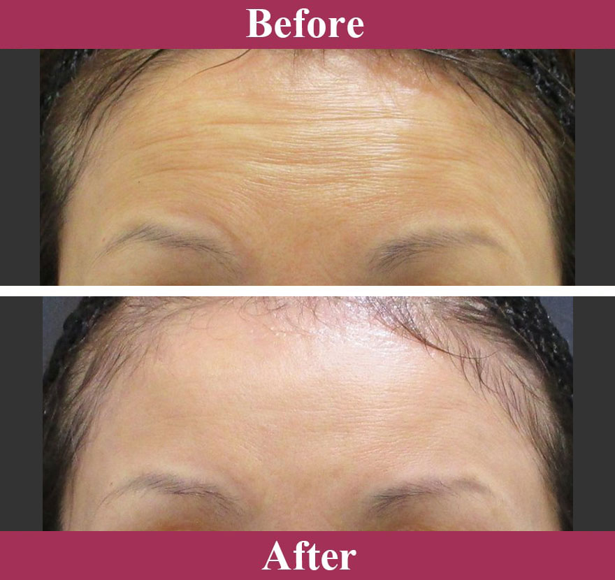 ボトックス注射（アラガン社製）症例写真【画像】