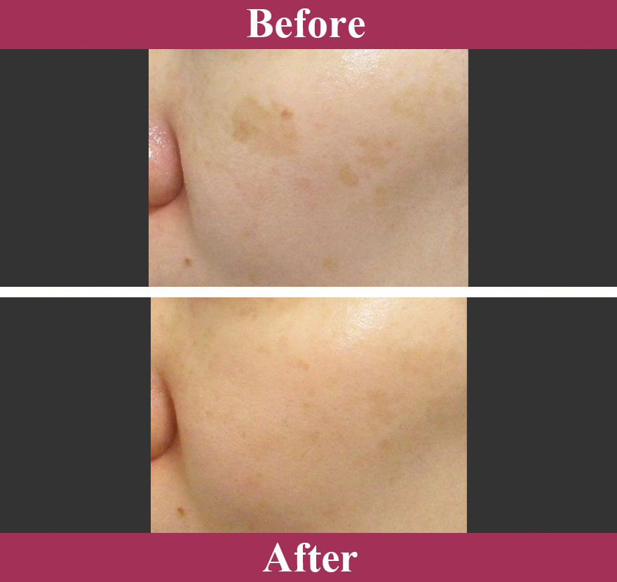 Qスイッチヤグレーザー症例写真【画像】