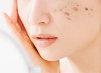 肝斑（かんぱん）