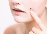 ほくろ除去・いぼ除去