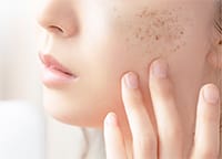 シミ・そばかす