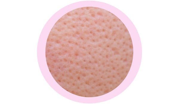 毛穴の開きやたるみ【画像】