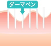ダーマペン【画像】