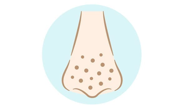 角栓によるいちご鼻【画像】