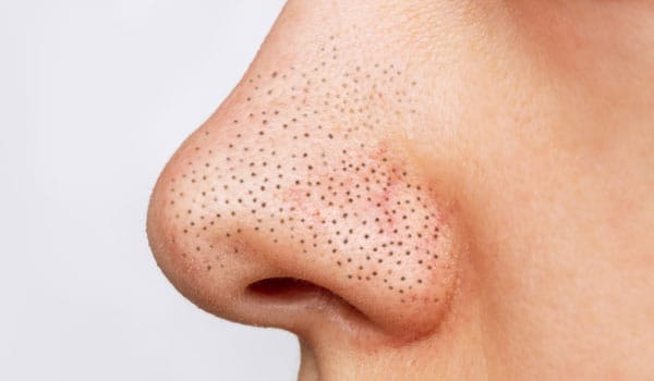 いちご鼻とは？【画像】