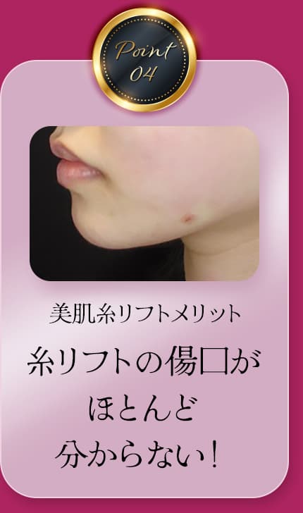 Point04 美肌糸リフトの利点 糸リフトの傷跡は全く目立ちません