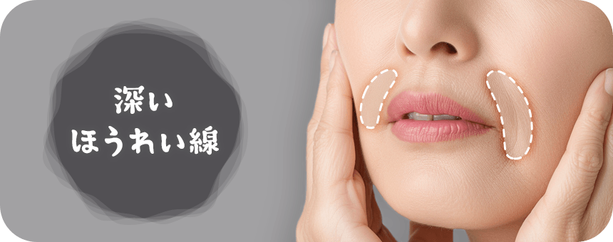 深く刻まれたほうれい線